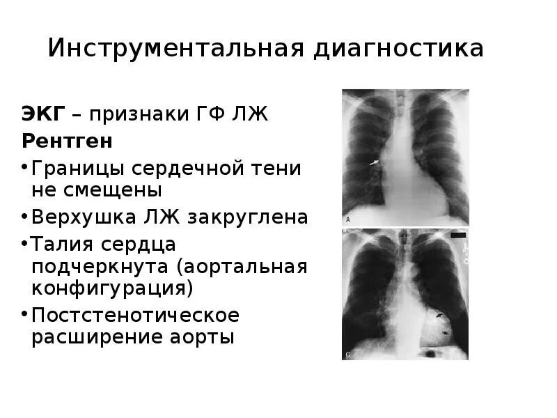 Что значит аорта уплотнена на флюорографии