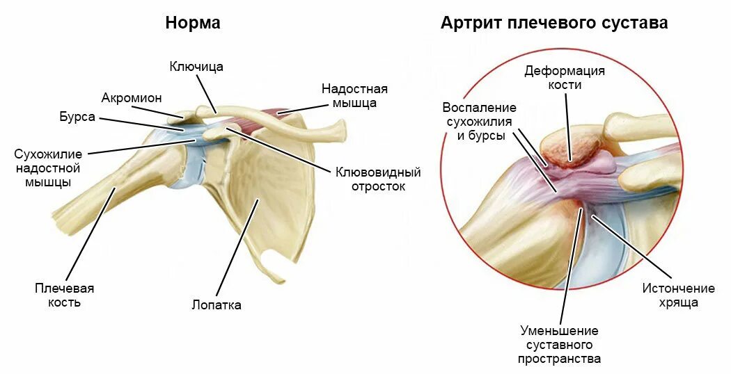 Эффективное лечение плечевого сустава. Ревматоидный артрит плеча. Строение плечевого сустава человека и болезни. Воспаление хряща плечевого сустава. Связки и сухожилия плечевого сустава анатомия.