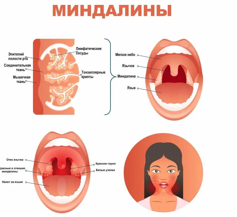 Фарингит тонзиллит скарлатина. Фарингит ангина хронический. Грипп. Отличие орви от бактериальной инфекции. Хронический тонзиллит факторы.