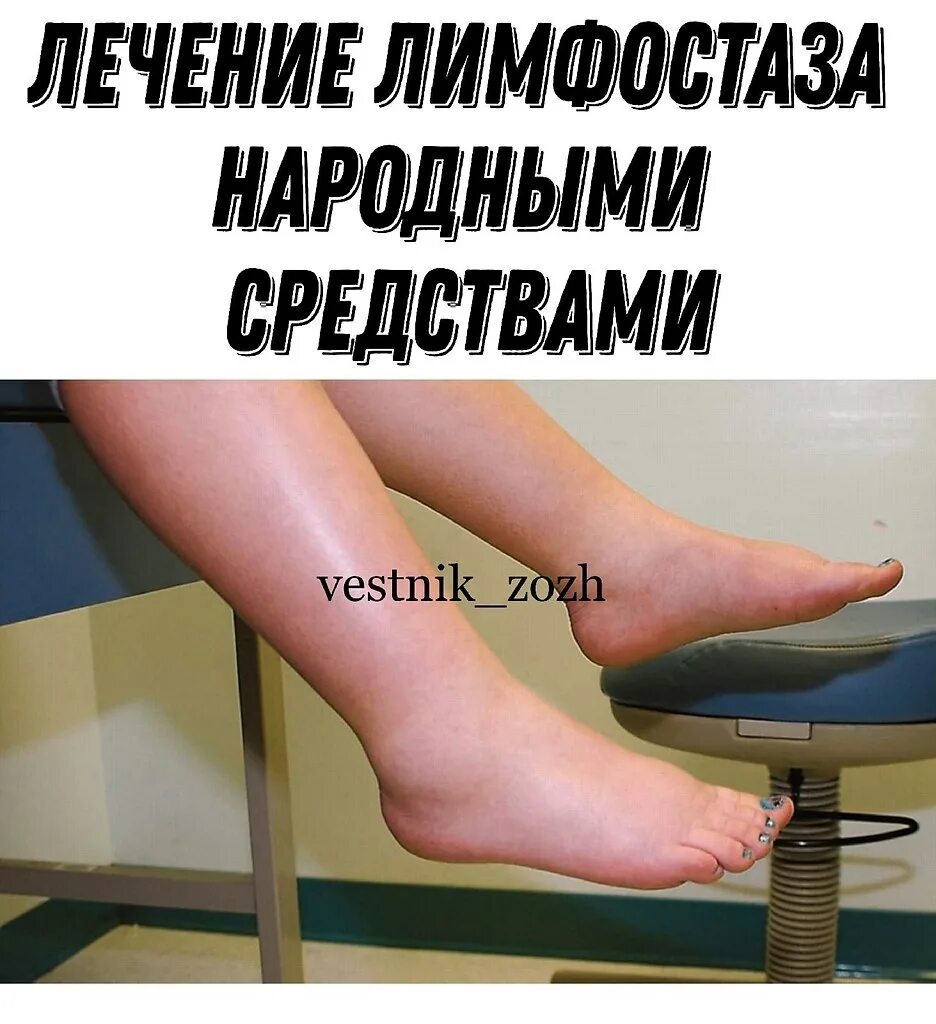 Что делать чтобы отеки быстрее прошли