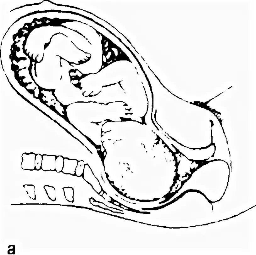 Периоды родов. Матка в первом периоде родов. Катетер перед родами для раскрытия шейки матки