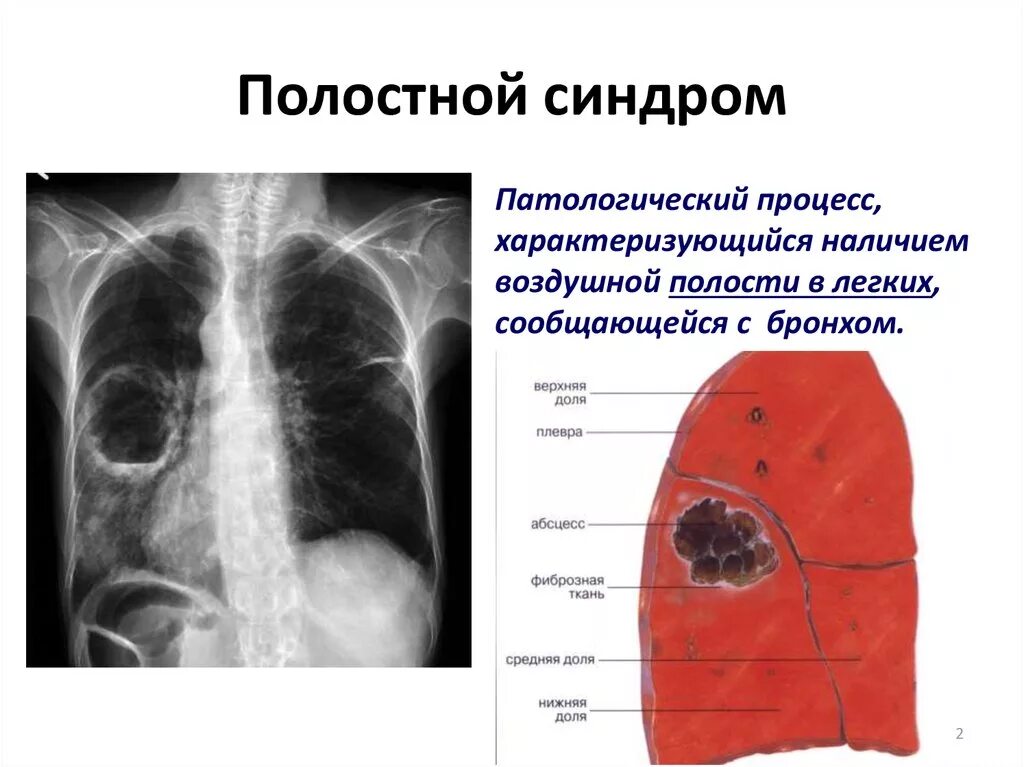 Образование полостей в легких