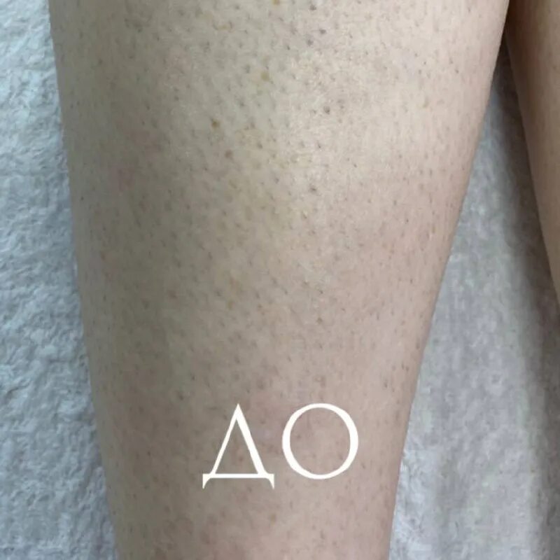 лазерная эпиляция промежуток