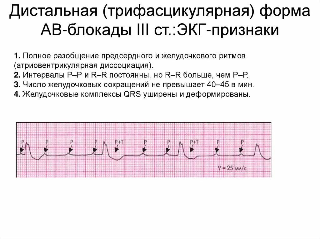 Атриовентрикулярная блокада 2. АВ блокада 2 степени классификация. АВ блокада 2 степени Мобитц 1 на ЭКГ. Блокада 2ст Мобитц 2. Дистальная АВ блокада 3 степени.