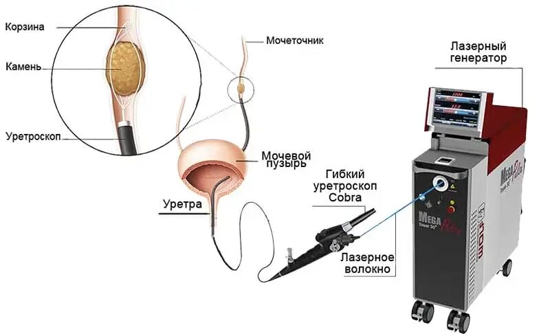 Как дробят камни в мочеточнике. Лазерное дробление камней в мочеточнике. Дробление лазером в мочеточнике лазером камней. Лазерная контактная литотрипсия камня мочеточника. Дробление камней в мочеточнике ультразвуком.