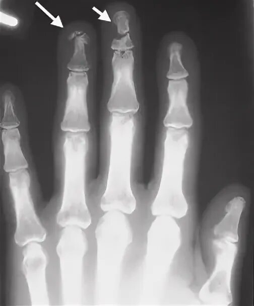 Boxer's Fracture - MEDizzy Journal