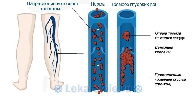 Профилактика тромбоза конечностей. Острый тромбофлебит нижних конечностей. Тромбофлебит глубоких сосудов нижних конечностей. Тромбоз глубоких вен (ТГВ) – что это такое?. Острый тромбоз сосудов нижних конечностей.