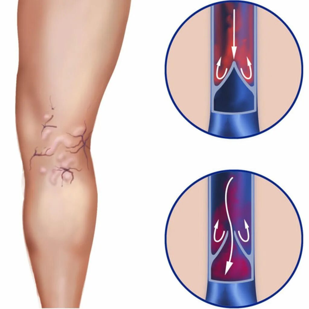 Поверхностный флебит, тромбофлебит. Острый тромбофлебит подкожных вен.. Облитерирующий атеросклероз гангрена. Лечение вен на ногах цена