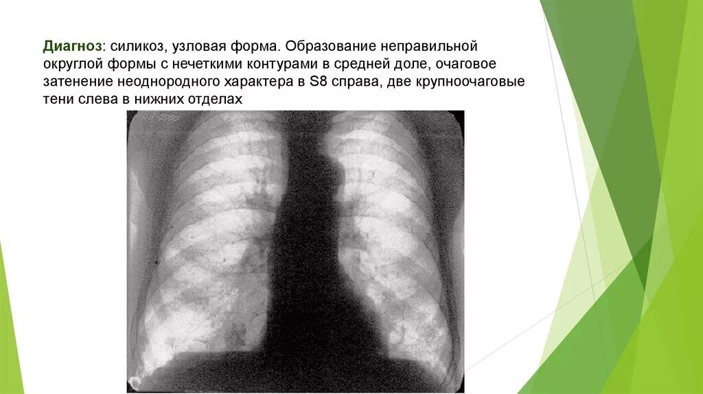 Округлыми формами в легком. Силикоз Узловая форма на рентгене. Узелковая форма силикоза рентген. Силикоз лёгких узелковая форма. Силикоз рентгенологические формы.