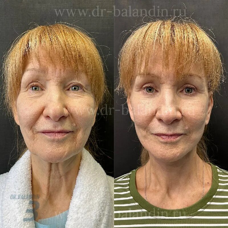 баландин пластический хирург