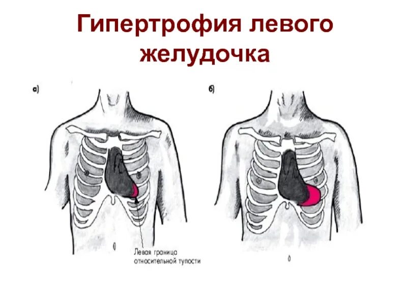 Гипертрофия левого желудочка смещение границ сердца. Гипертрофия левого желудочка сердца перкуссия. Смещение границ относительной сердечной тупости влево. Смещение границ сердечной тупости при гипертрофии.