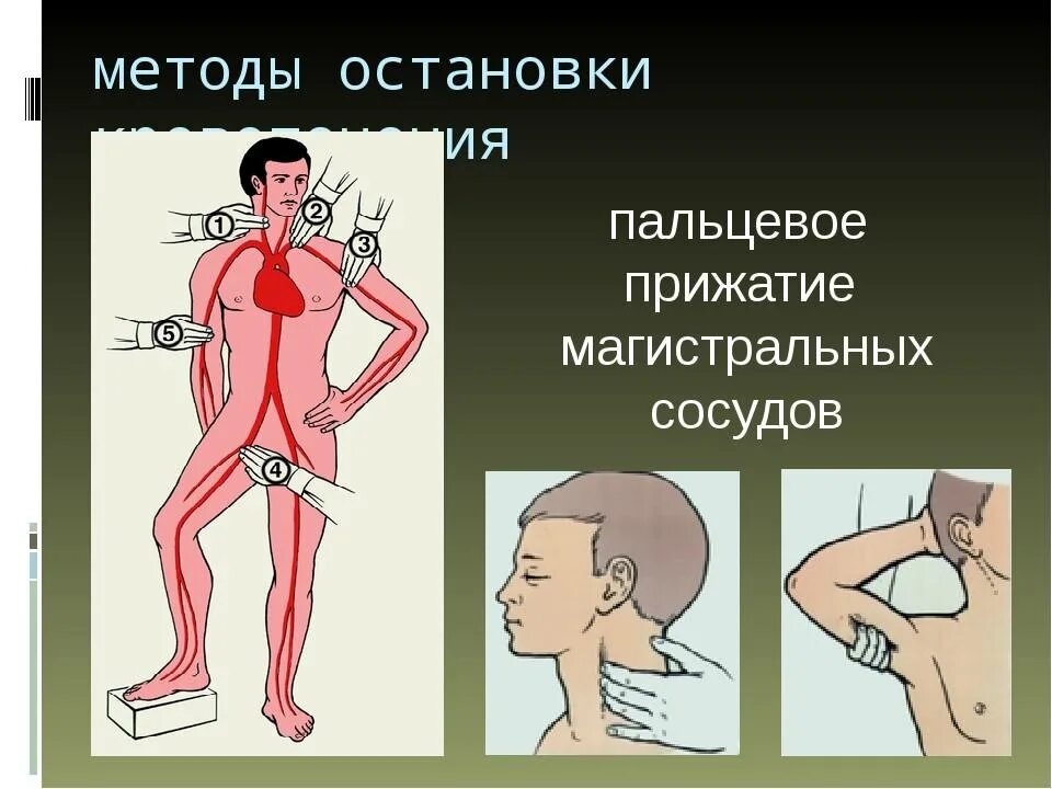 Способы остановки кровотечения пальцевое прижатие артерии. Пальцевое прижатие магистральных сосудов. Способы пальцевого прижатия сосудов. Точки прижатия артерий для остановки кровотечения. Методы прижатия артерий.