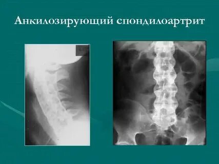 Анкилозирующий спондилит что это