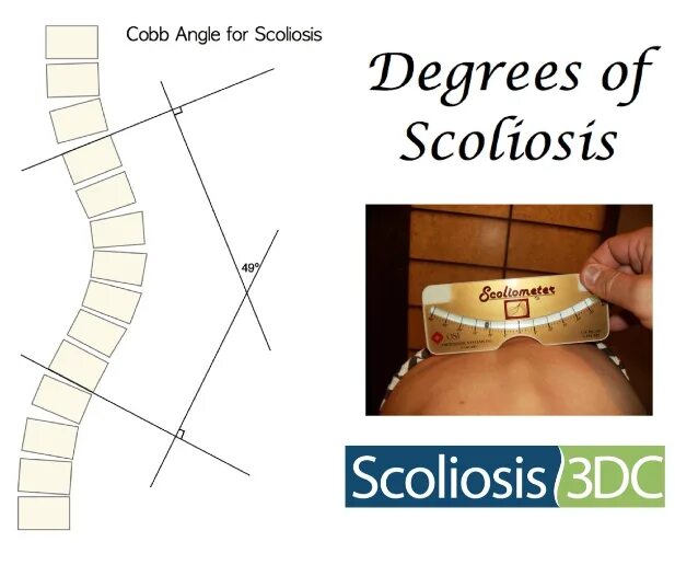Измерение угла сколиоза по коббу. Угол Кобба степени сколиоза. Угол кобба