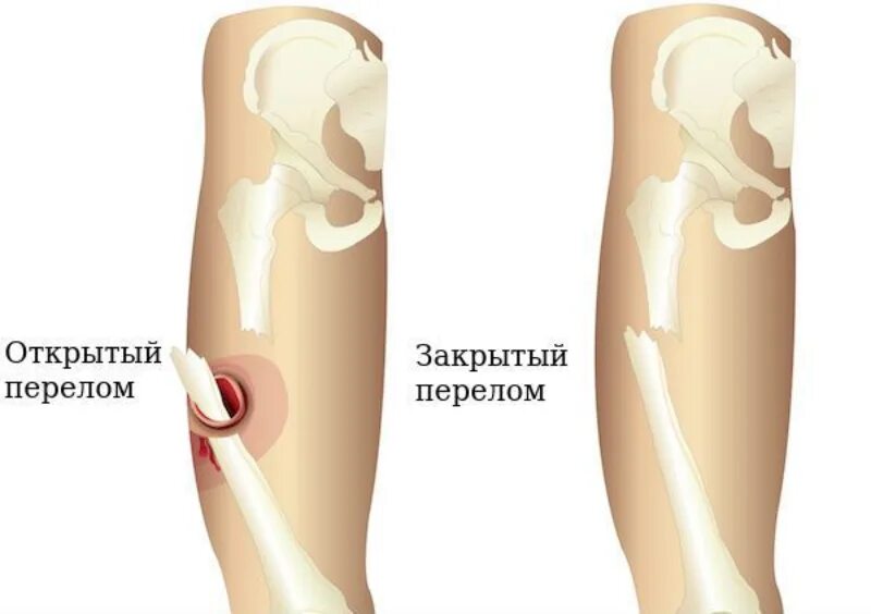 Открытые и закрытые переломы. Перелом откры и закрытый.