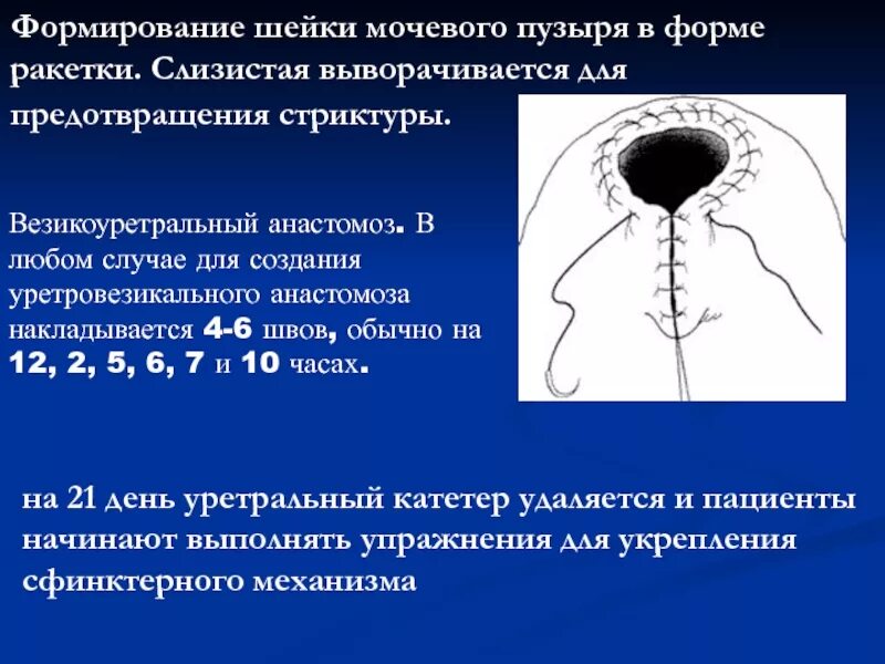 Уретровезикальный анастомоз. Формирование соустья мочевого пузыря. Формирования шейки мочевого пузыря. Анастомоз мочевого пузыря. Операция шейки мочевого пузыря