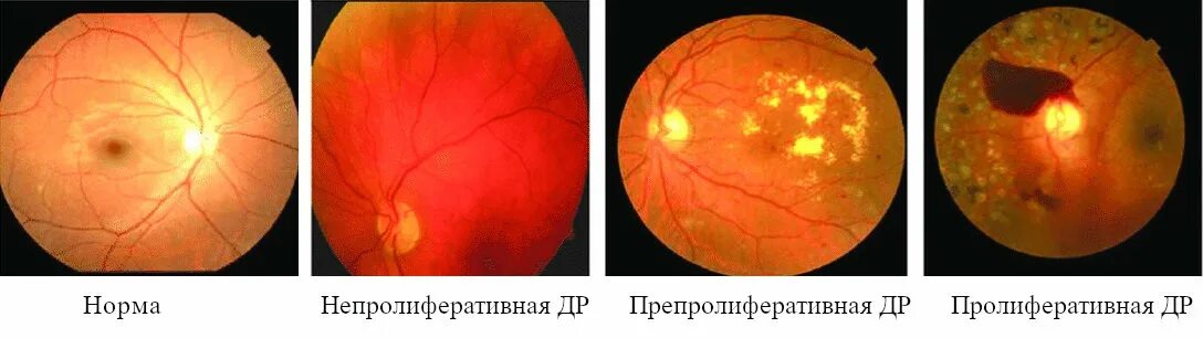 Операция ретинопатии. Пролиферативная диабетическая ретинопатия. ретинопатия недоношенных. классификация диабетической ретинопатии.