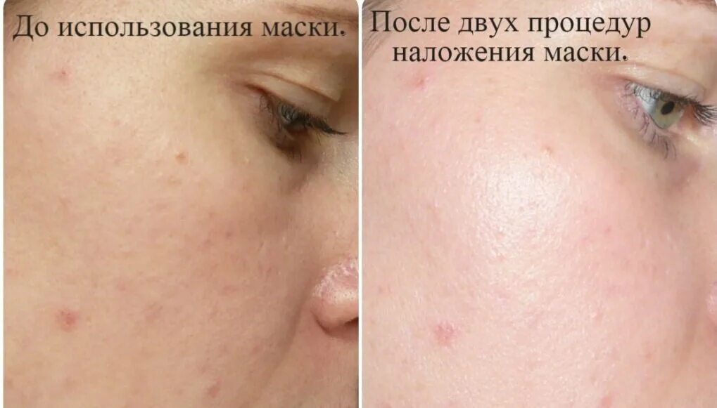 Маски для лица до и после. Альгинатная маска до и после. Альгинатная маска для лица до и после. Альгиновая маска до и после. Альгинатная маска до и после фото.