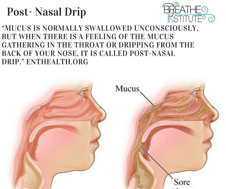 Постринальный синдром. Синдром постназального затекания. Слизь в горле и кашель как избавиться