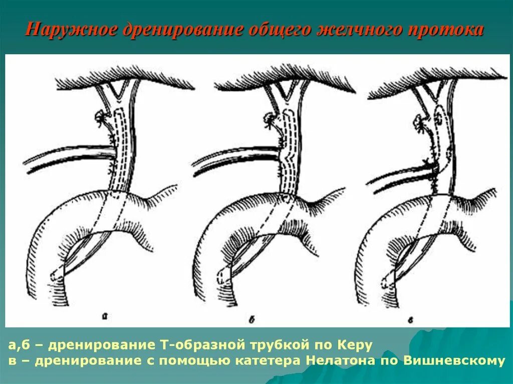 Трубка в желчном пузыре. Наружное и внутреннее дренирование желчных протоков. Дренирование желчных протоков. Дренирование внепеченочных желчных протоков. Операции на желчных путях при механической желтухе.