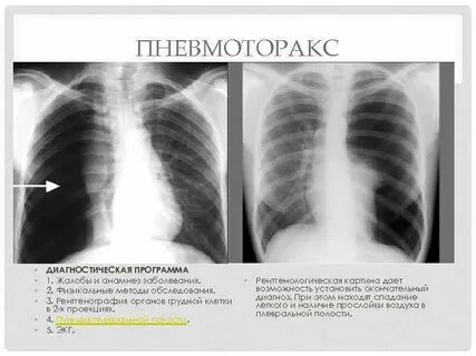 Пневмоторакс рентген