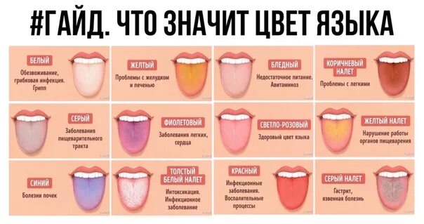 Заболевания по цвету языка. Желучный налет на языке. Язык за 2 недели