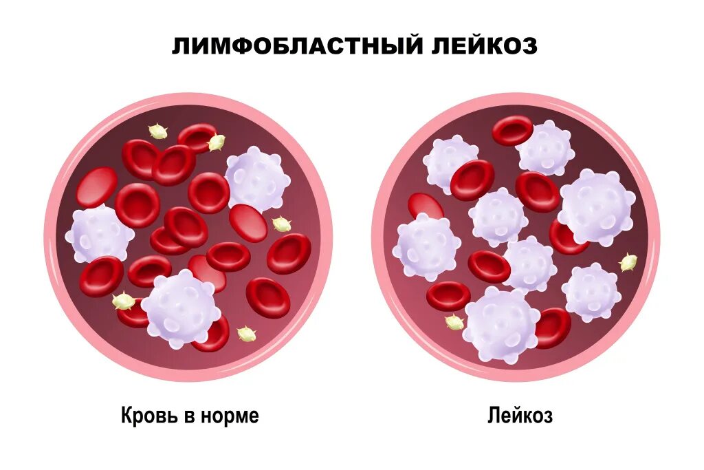 Лейкоз эритроциты. White blood cell-red blood cells. лейкоз вектор.