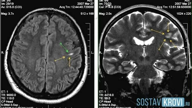 Очаги в белом веществе сосудистого характера. Очаги в белом веществе головного мозга мрт. Единичные очаговые изменения вещества мозга. Кистозно-глиозные изменения головного мозга кт. Множественные очаги глиоза мрт.