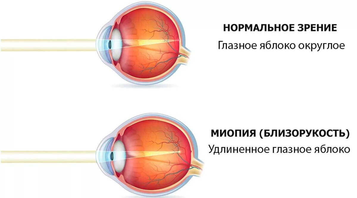 Зрение вблизи то хуже то лучше