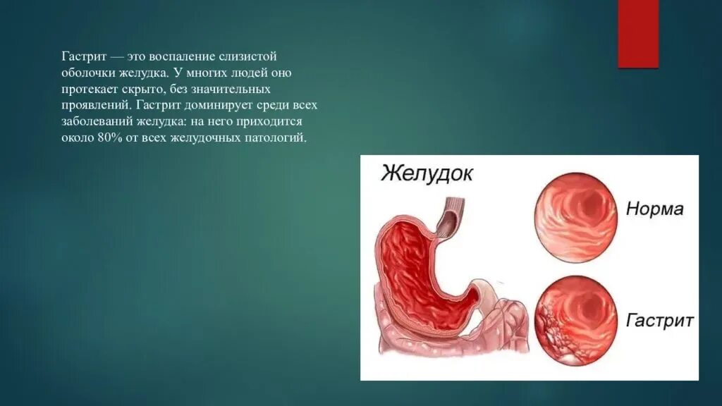 Хронический гастрит тема. Гастрит сообщение по биологии 8 класс. Острый и хронический гастрит.