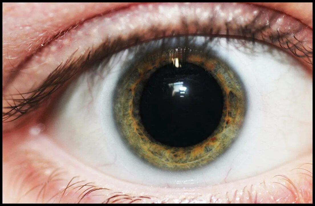 Почему увеличивается глаза. Паралитический мидриаз. Травматический мидриаз. Травматический мидриаз глаза. Мидриаз расширение зрачка.