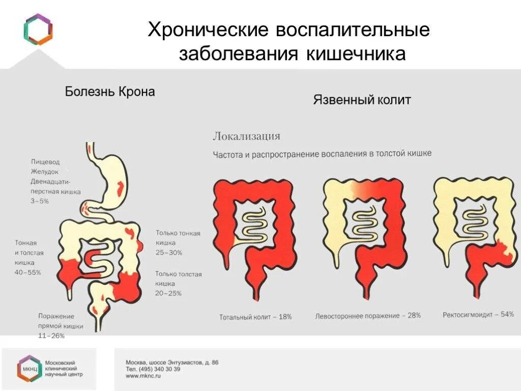 Вызывает заболевание кишечника. Язвенный колит поражение кишки. Няк воспаление кишечника. Няк поражение Толстого кишечника.