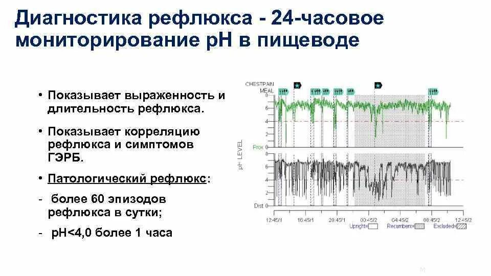 Диагноз d 38.1. Как диагностировать рефлюкс. 24 Часовая PH метрия пищевода. Внутрипищеводное РН-мониторирование. Суточное PH мониторирование при ГЭРБ.