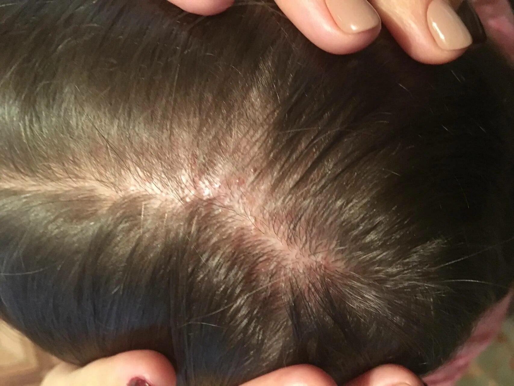 раздражённая кожа головы. чистая кожа головы. почему чешется голова у женщины. чесание головы. почему чешется голова у женщины.