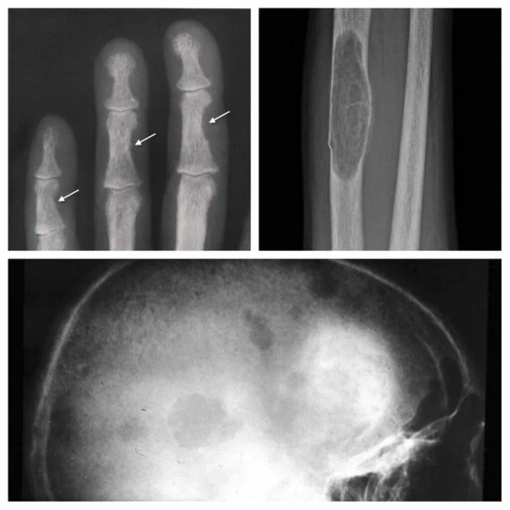Вторичное поражение костей. Гиперпаратиреоз кт костей. Гиперпаратиреоз рентген. Фиброзная остеодистрофия рентген. Гиперпаратиреоз рентген кистей.