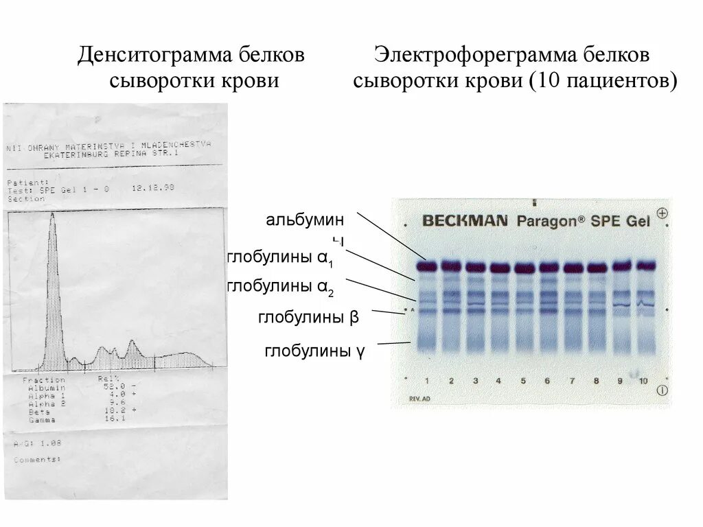 Соотношение белковых фракций методом электрофореза. Электрофорез белков плазмы норма. метод электрофореза белковых фракций.