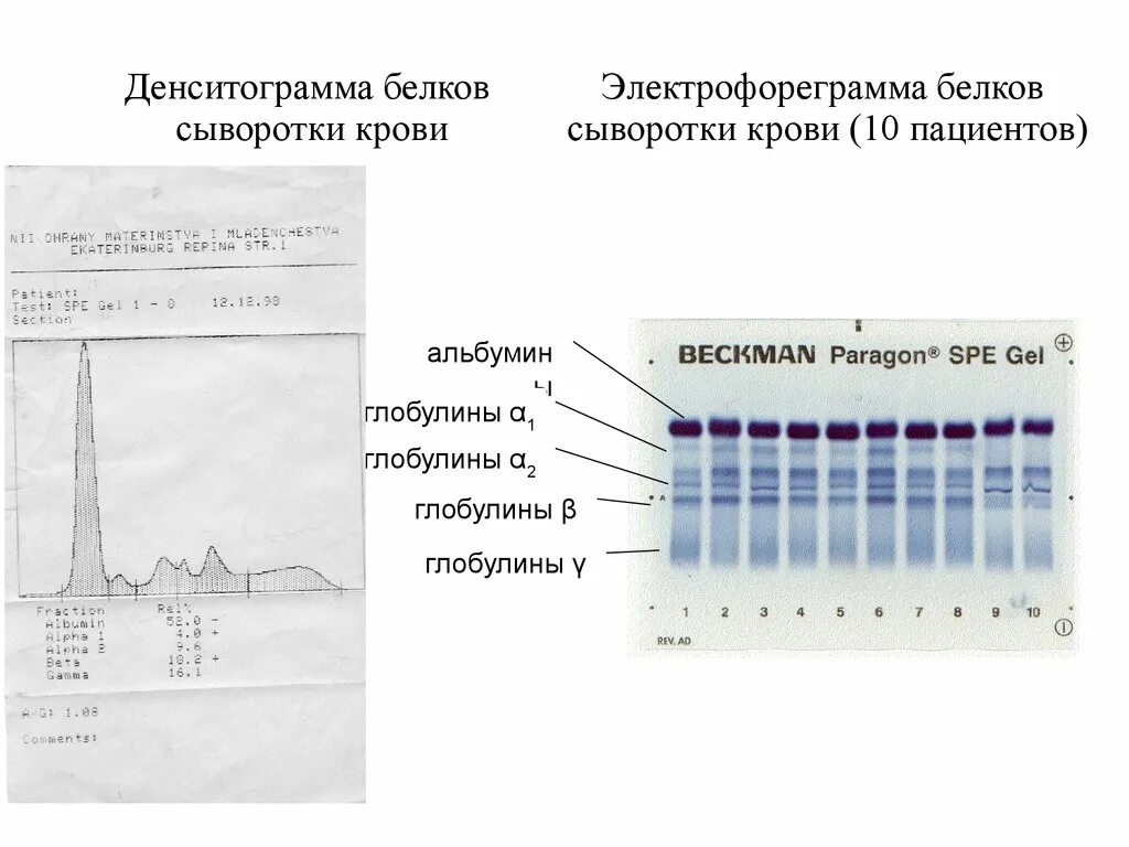 Белки белковые фракции. Электрофореграмма белков сыворотки крови. Электрофорез белков плазмы норма. Электрофорез белков сыворотки. Электрофорез белков сыворотки крови принцип метода.