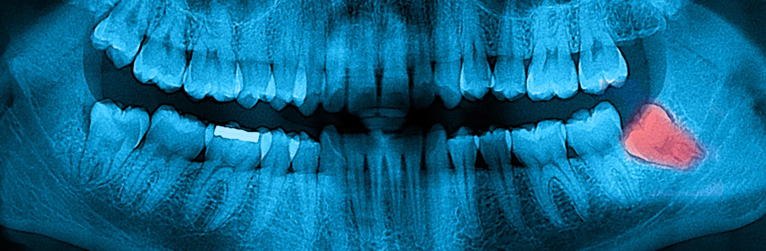 Пришеечная эрозия эмали. Виниры на тетрациклиновые зубы. Цветные зубы. Серые зубы. Серые зубы.