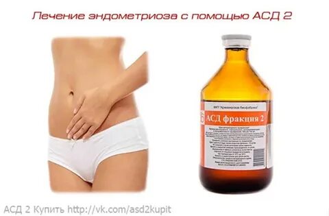 Лечение эндометриоза народными средствами