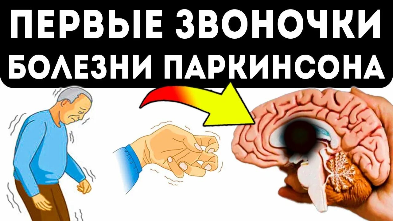 Излечение болезни паркинсона. Болезнь паркинсона картинки. Сытин паркинсон. Болезнь паркинсона картинки. Parkinson's disease.