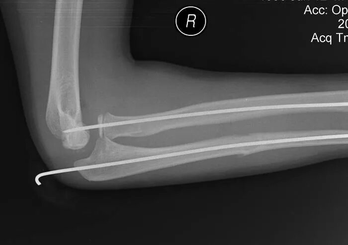 болит локоть после перелома. болит локоть после перелома. лечебная гимнастика при болезни паркинсона. реабилитация после перелома. Elbow pain.