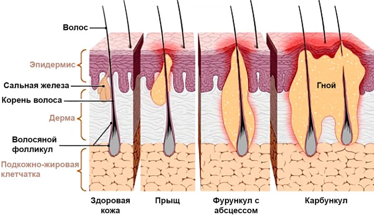 ГЛАВА 11 ХИРУРГИЧЕСКАЯ ИНФЕКЦИЯ (ГНОЙНО-ВОСПАЛИТЕЛЬНЫЕ ЗАБОЛЕВАНИЯ)