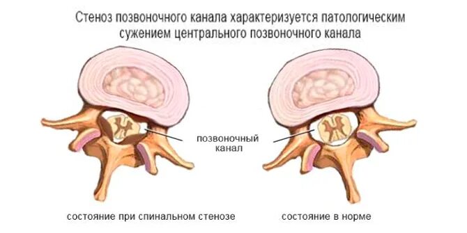 Поясничный абсолютный стеноз