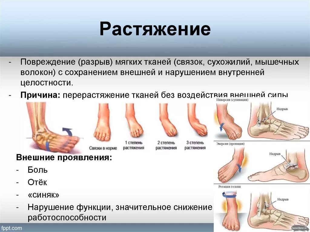 Растяжение виды. Признаки повреждений растяжение связок. симптомы повреждения растяжения. растяжения, разрывы связок и мышц. растяжение связок мышц сухожилий первая помощь.