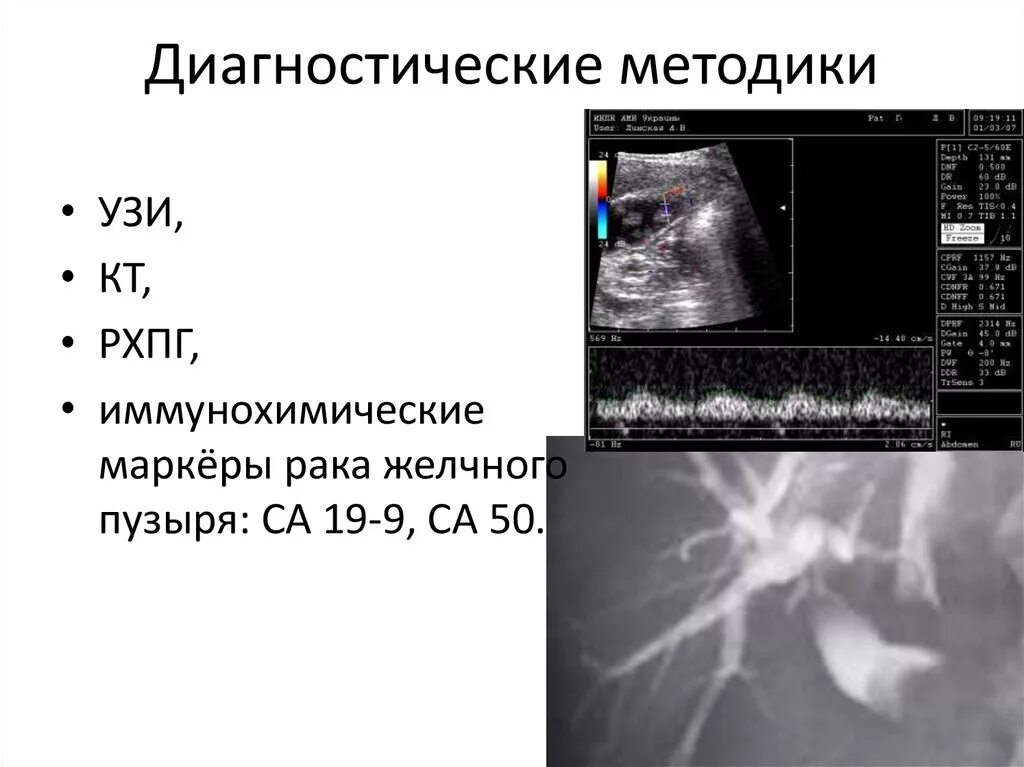 Карцинома желчного пузыря кт. Объемное образование желчного пузыря УЗИ. Опухоль желчного пузыря на УЗИ. Карцинома желчного пузыря УЗИ.