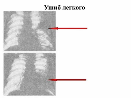 Падение легких
