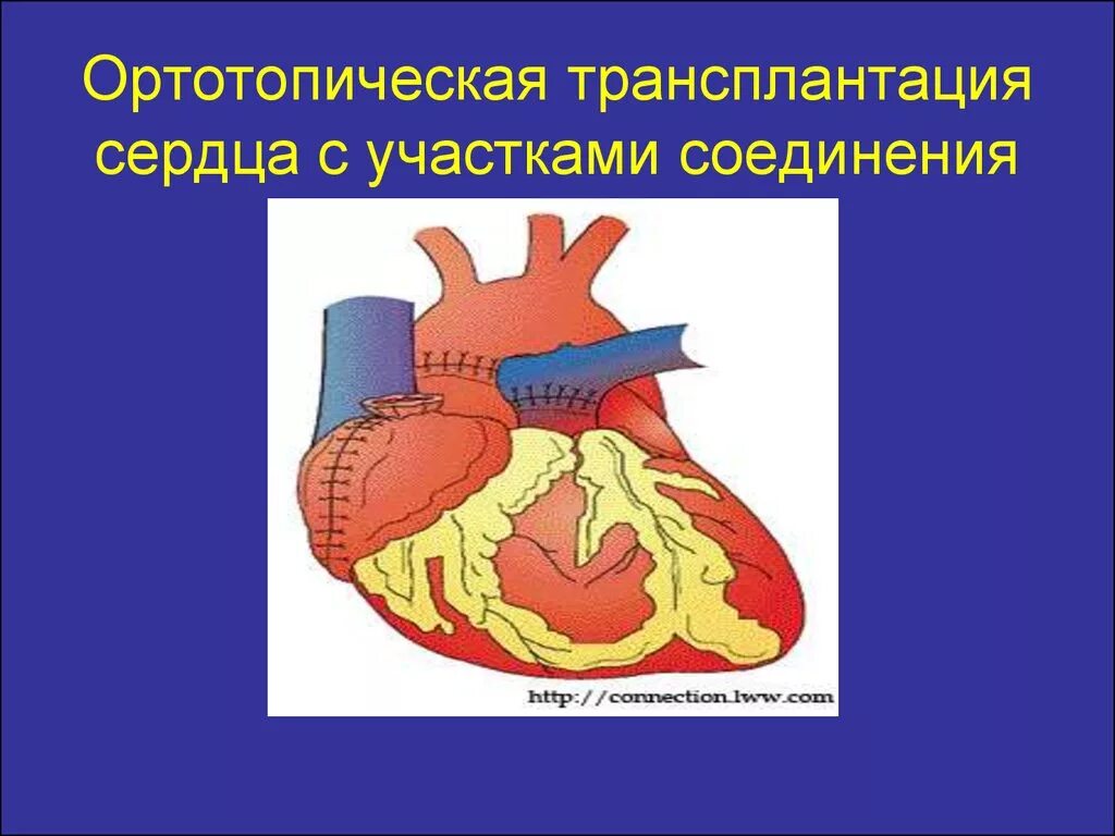 Тест нмо трансплантация сердца наличие трансплантированного сердца. Ортотопическая трансплантация. гетеротопическая и ортотопическая трансплантация сердца. ортотопическая пересадка сердца. техника ортотопической трансплантации сердца.