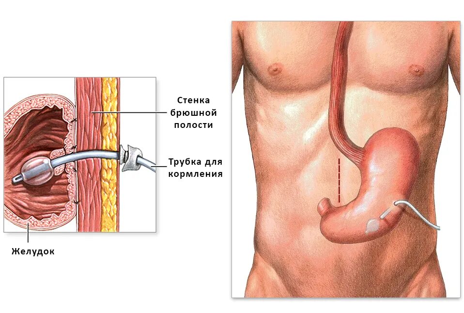 Сними трубочку. Гастростома свищ желудка. Строение трубки гастростомы. Гастростома для энтерального питания. Трубчатая гастростома.