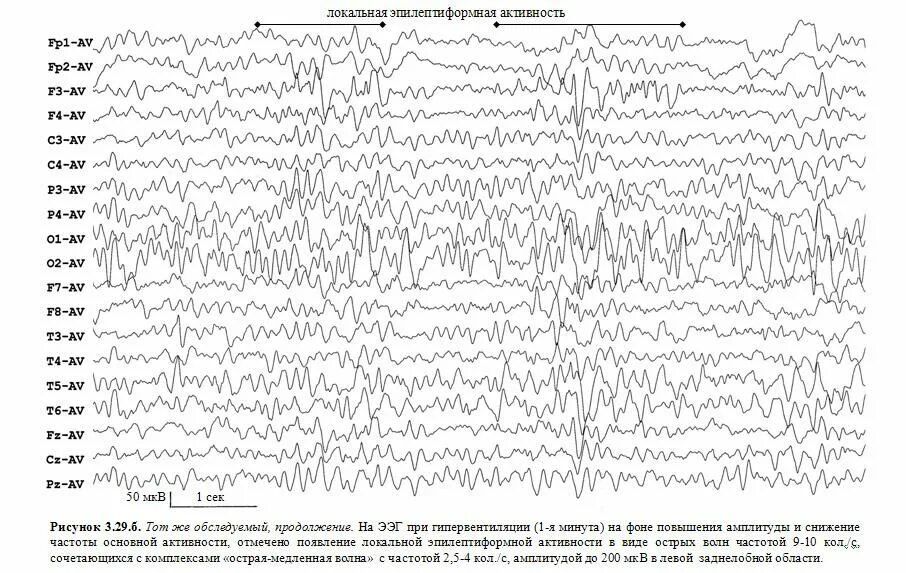 Эпи ээг. Эпилептическая активность на ЭЭГ. ЭЭГ спайки и острые волны. Региональная эпилептиформная активность ЭЭГ. Пик волна на ЭЭГ.