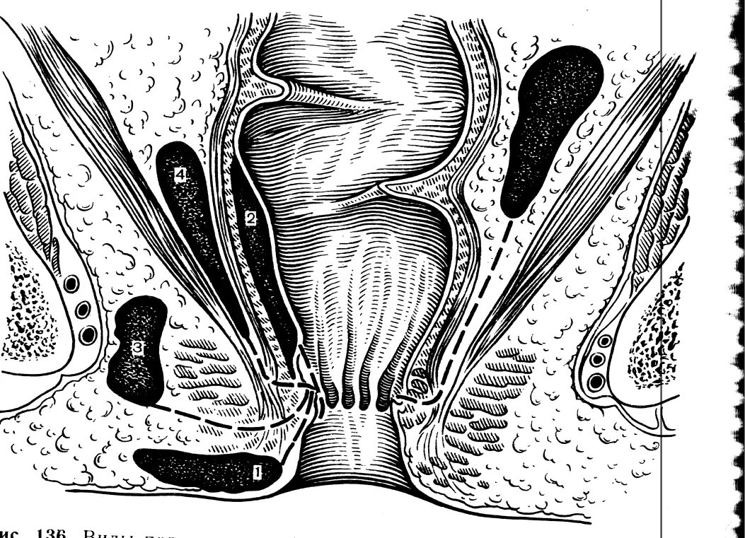 Трещины заднего прохода цена. Пельвиоректальный проктит. Пельвиоректальный парапроктит дренирование. Парапроктит подкожный абсцесс. Острый пельвиоректальный парапроктит.